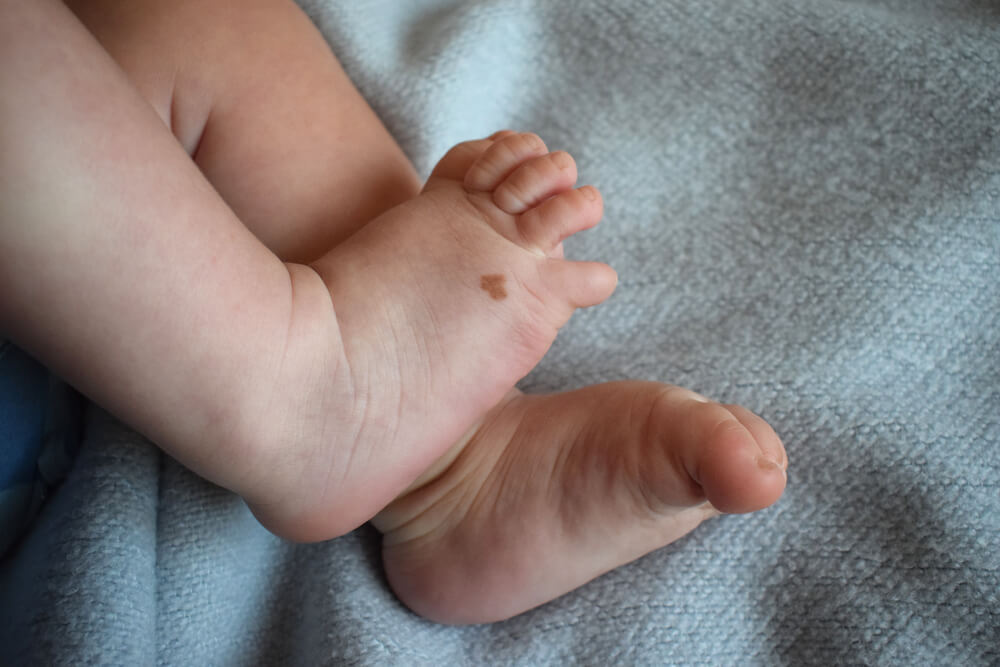 Simak Fakta Tentang Tanda Lahir pada Bayi Berikut!