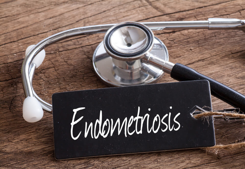 Kenali Fakta dan Mitos Seputar Endometriosis